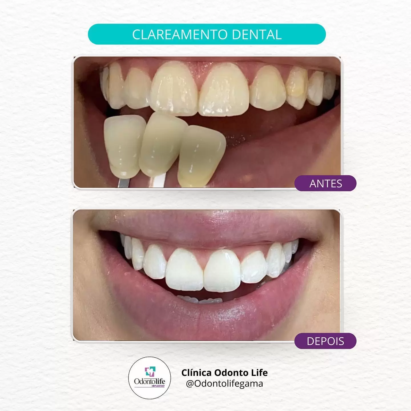clínica odontolife gama - transformação 10